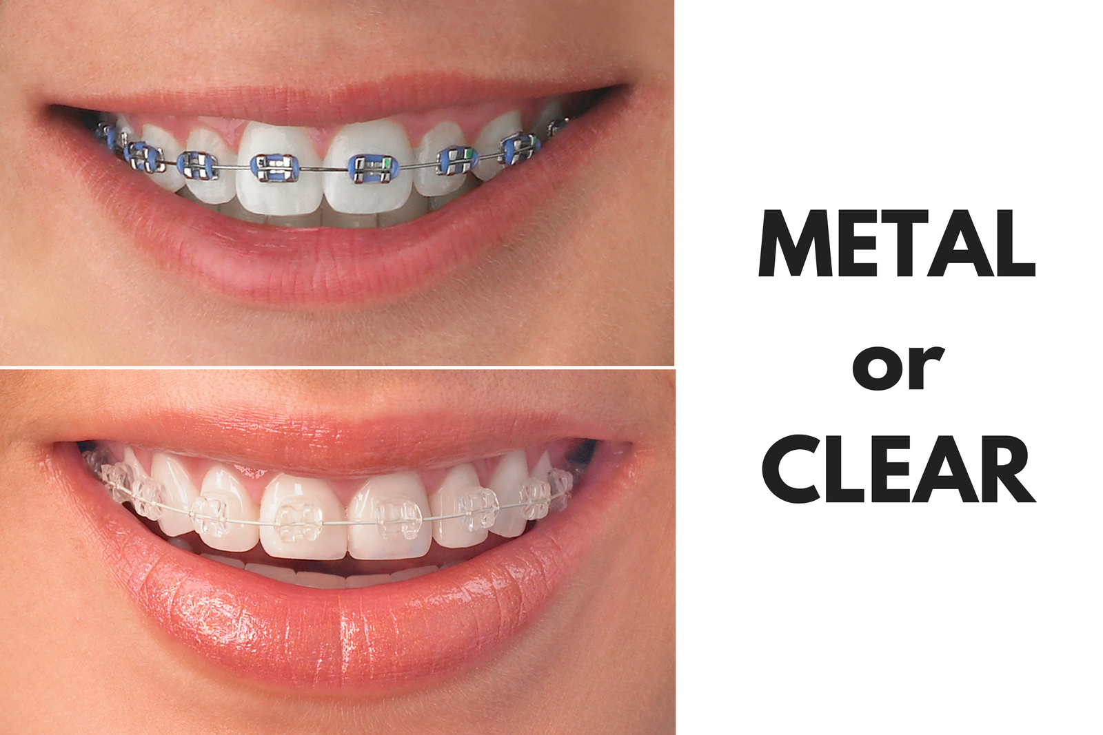 Ask Your College Station Dentist: Should I Get Metal or Clear Braces?